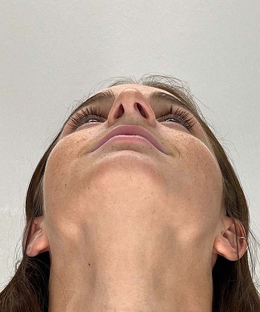 Rhinoplasty Before & After