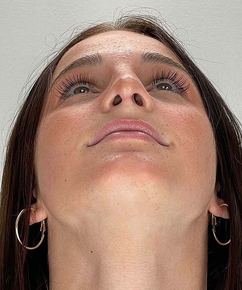 Rhinoplasty Before & After