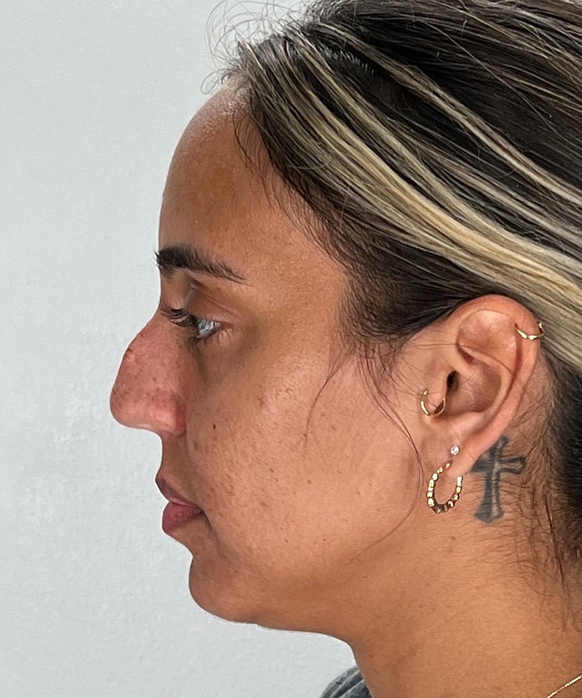 Rhinoplasty Before & After