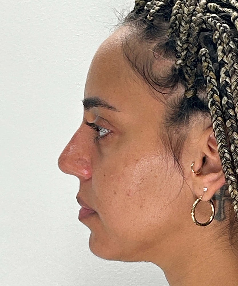 Rhinoplasty Before & After