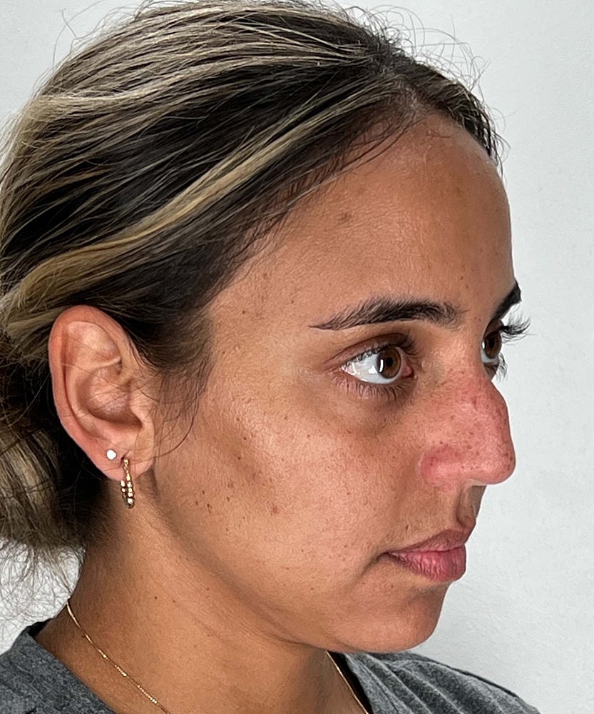 Rhinoplasty Before & After