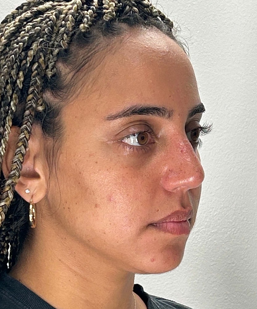 Rhinoplasty Before & After