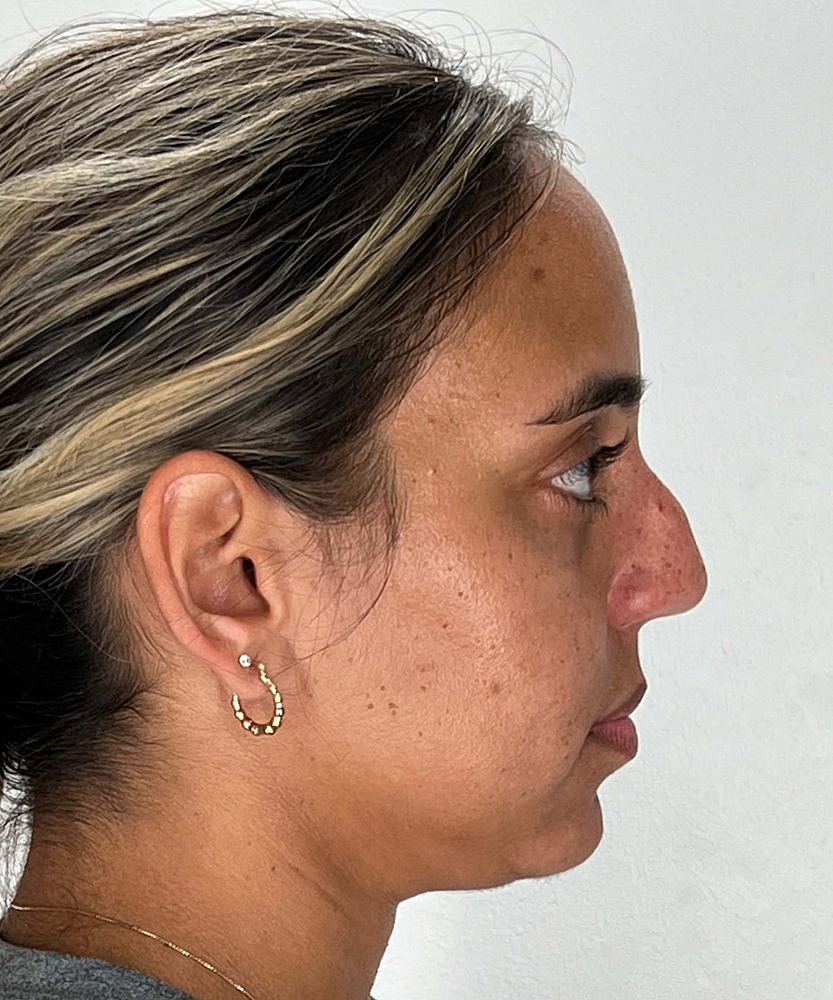 Rhinoplasty Before & After