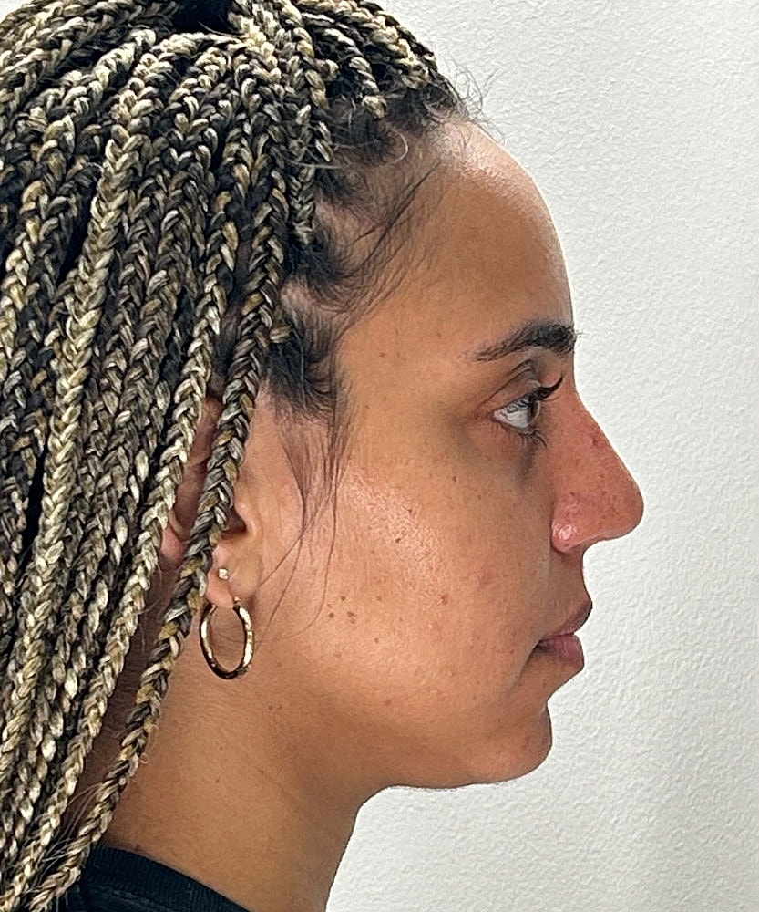 Rhinoplasty Before & After