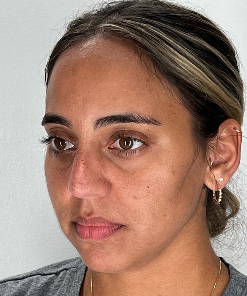 Rhinoplasty Before & After