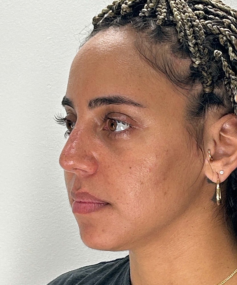 Rhinoplasty Before & After