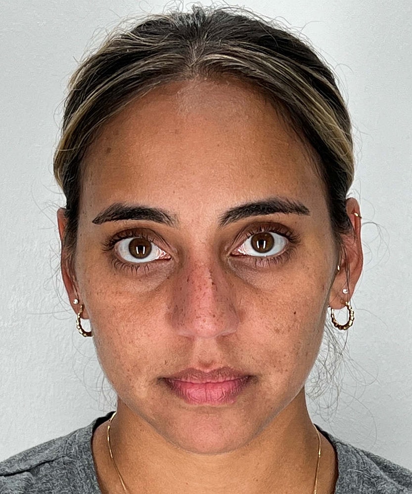 Rhinoplasty Before & After