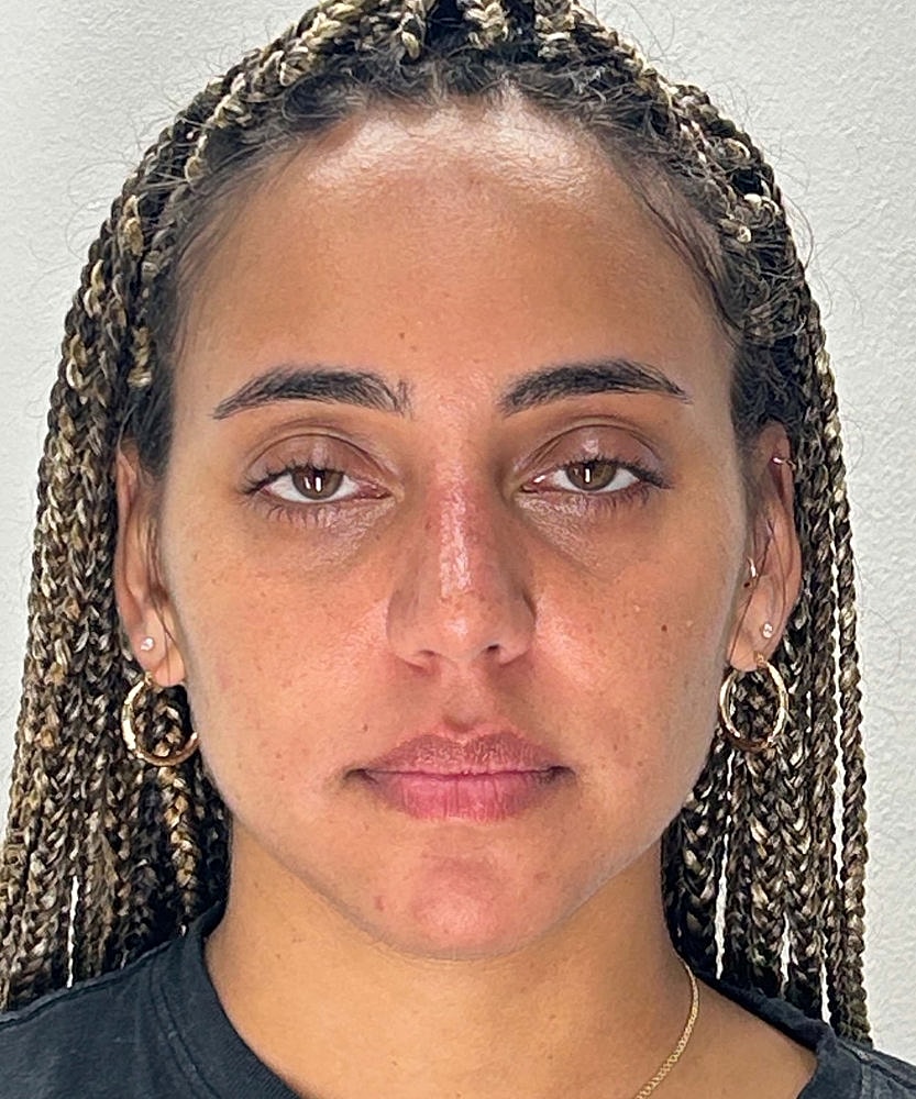 Rhinoplasty Before & After