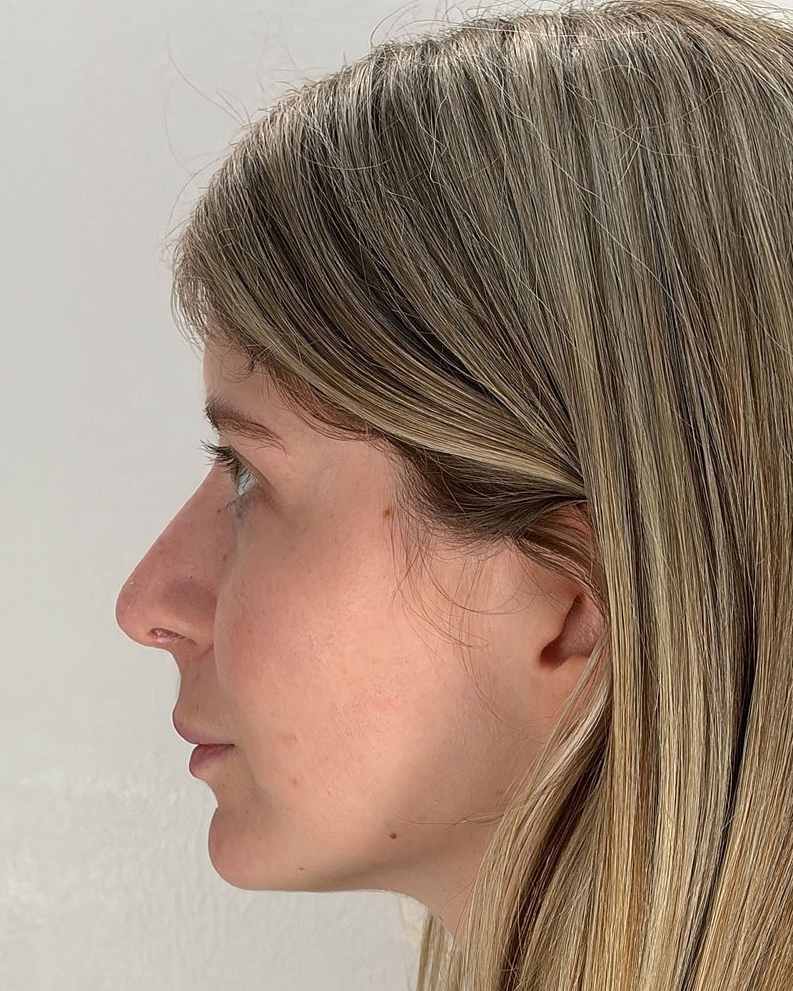 Rhinoplasty Gallery Before & After