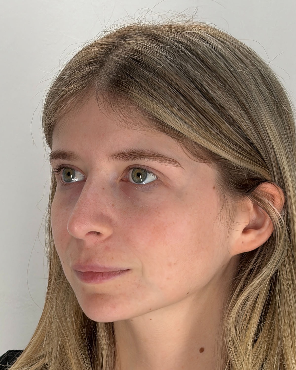 Rhinoplasty Gallery Before & After
