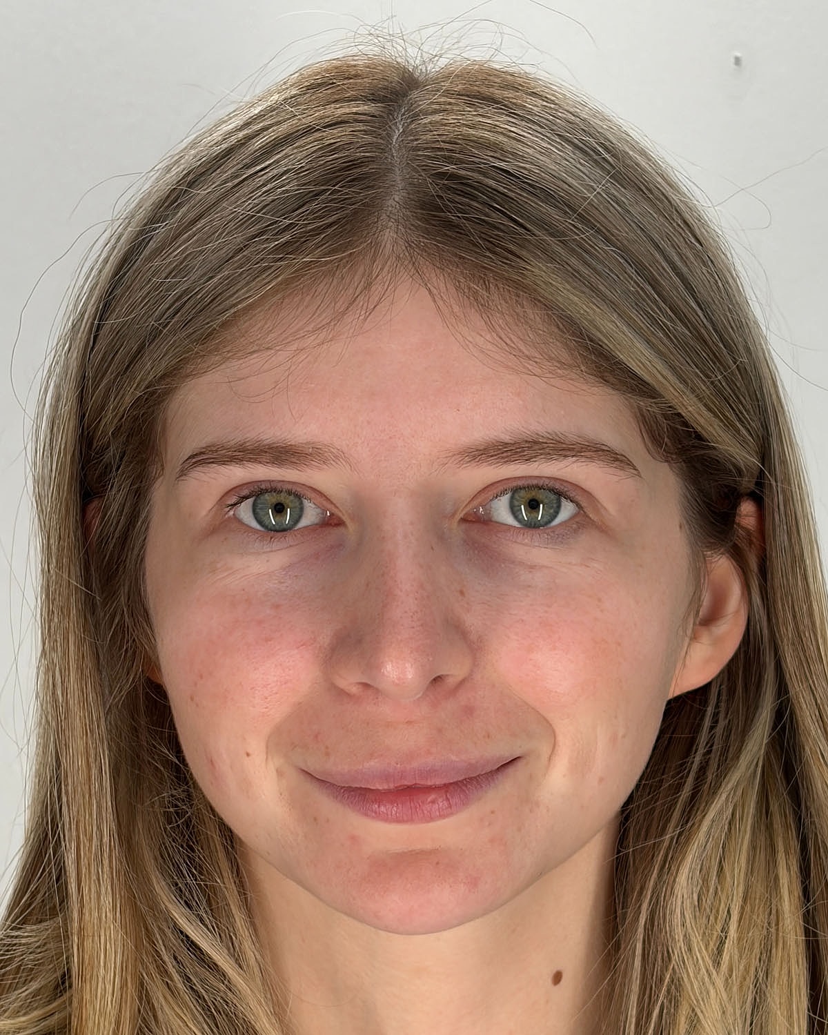 Rhinoplasty Gallery Before & After