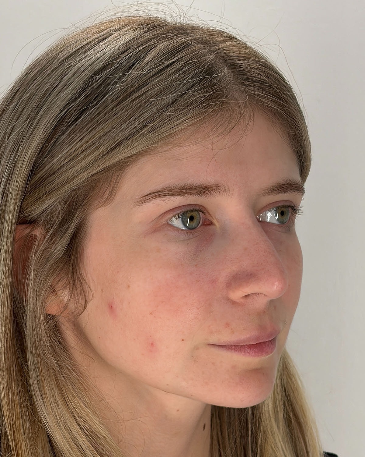 Rhinoplasty Gallery Before & After