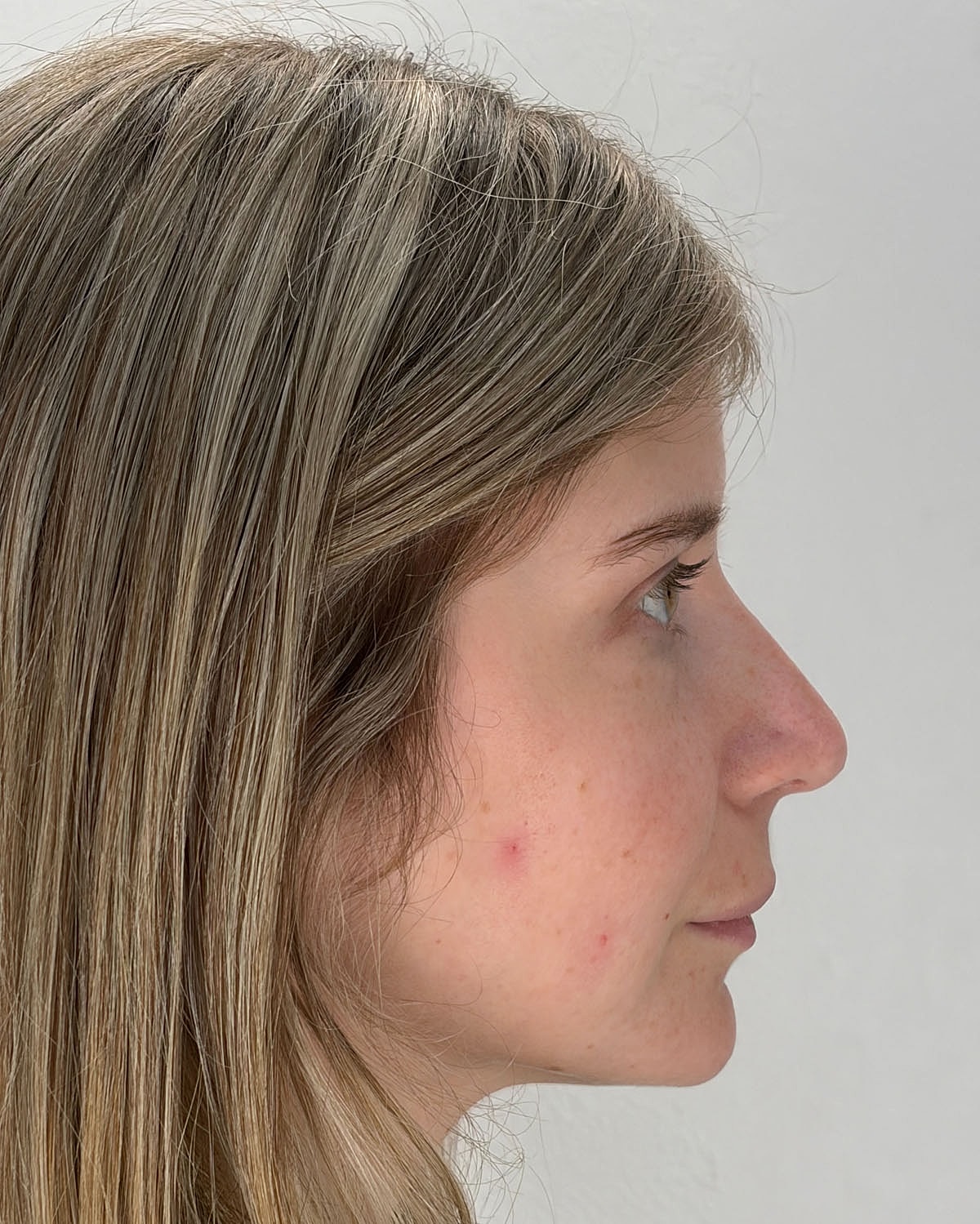Rhinoplasty Gallery Before & After