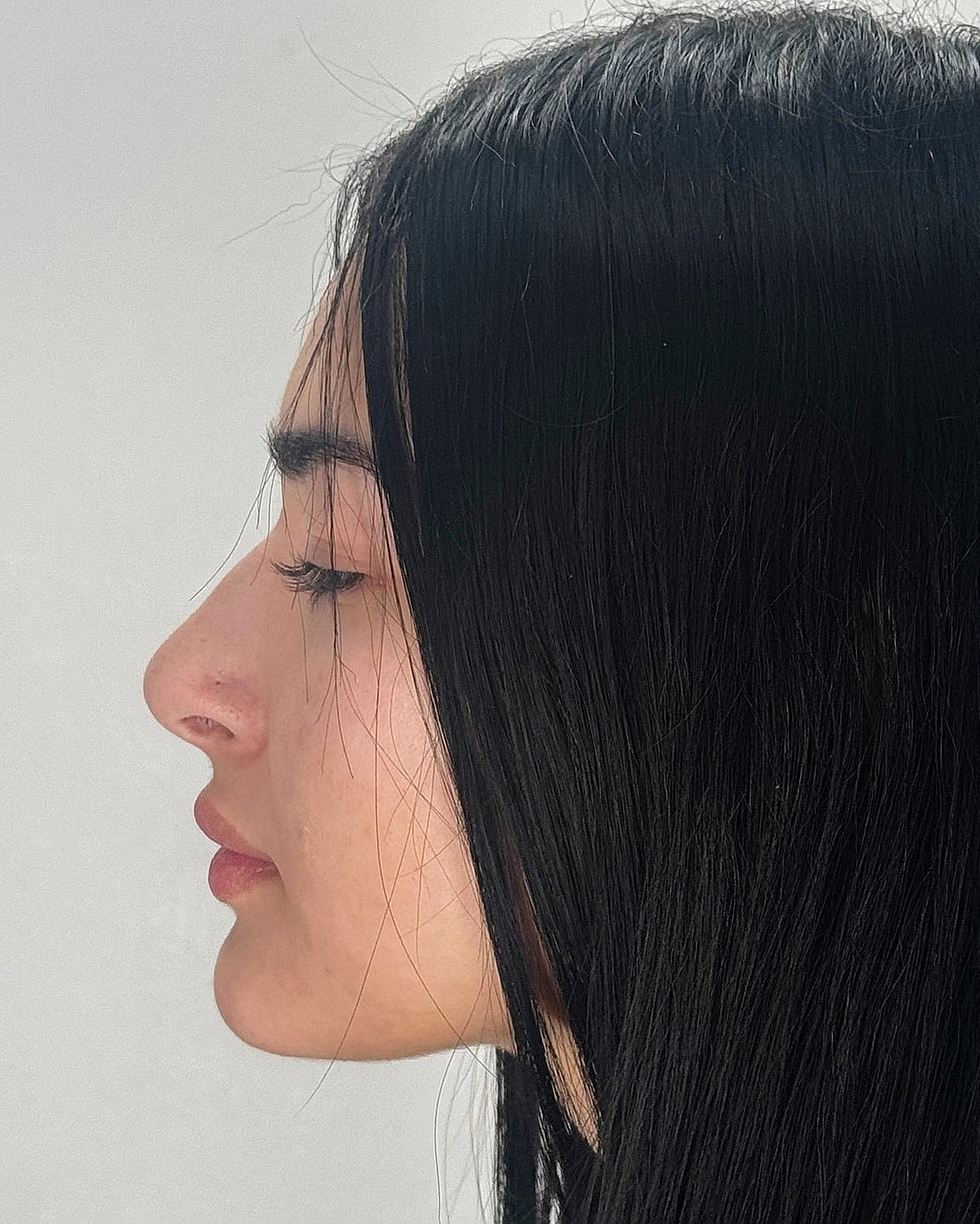 Rhinoplasty Before & After