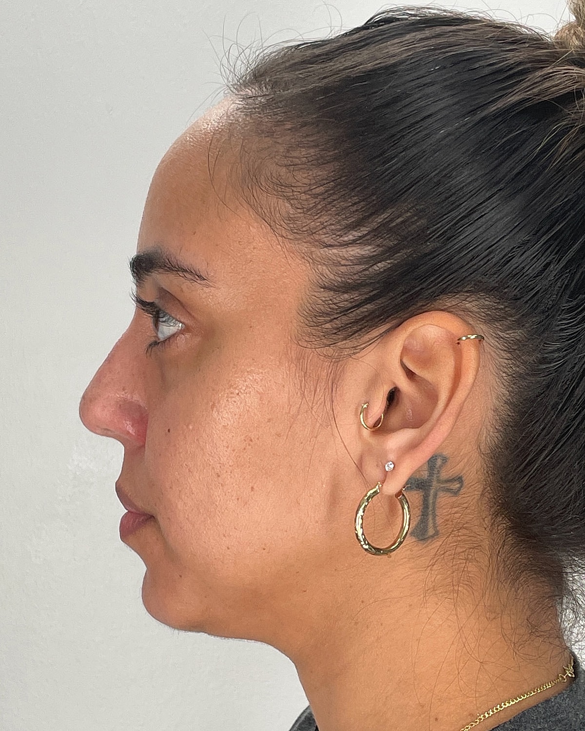 Rhinoplasty Before & After