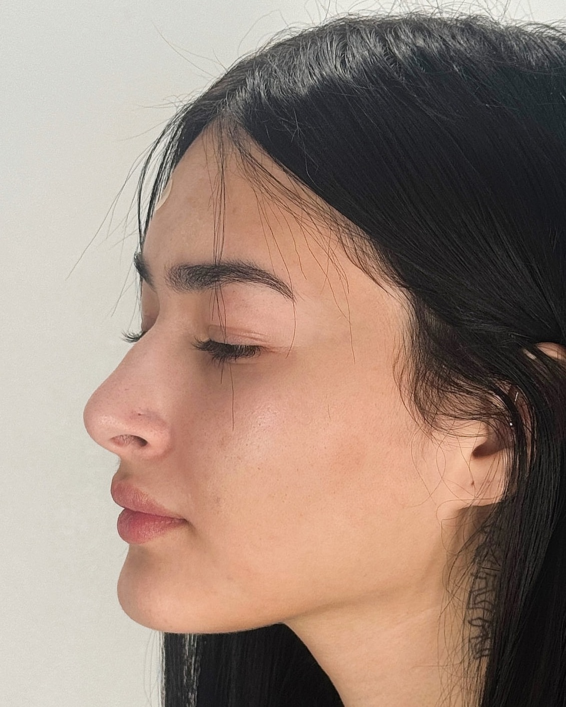 Rhinoplasty Before & After