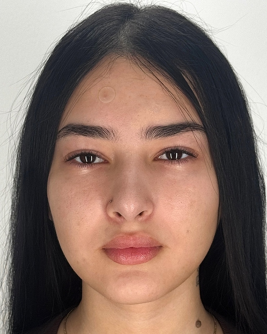 Rhinoplasty Before & After