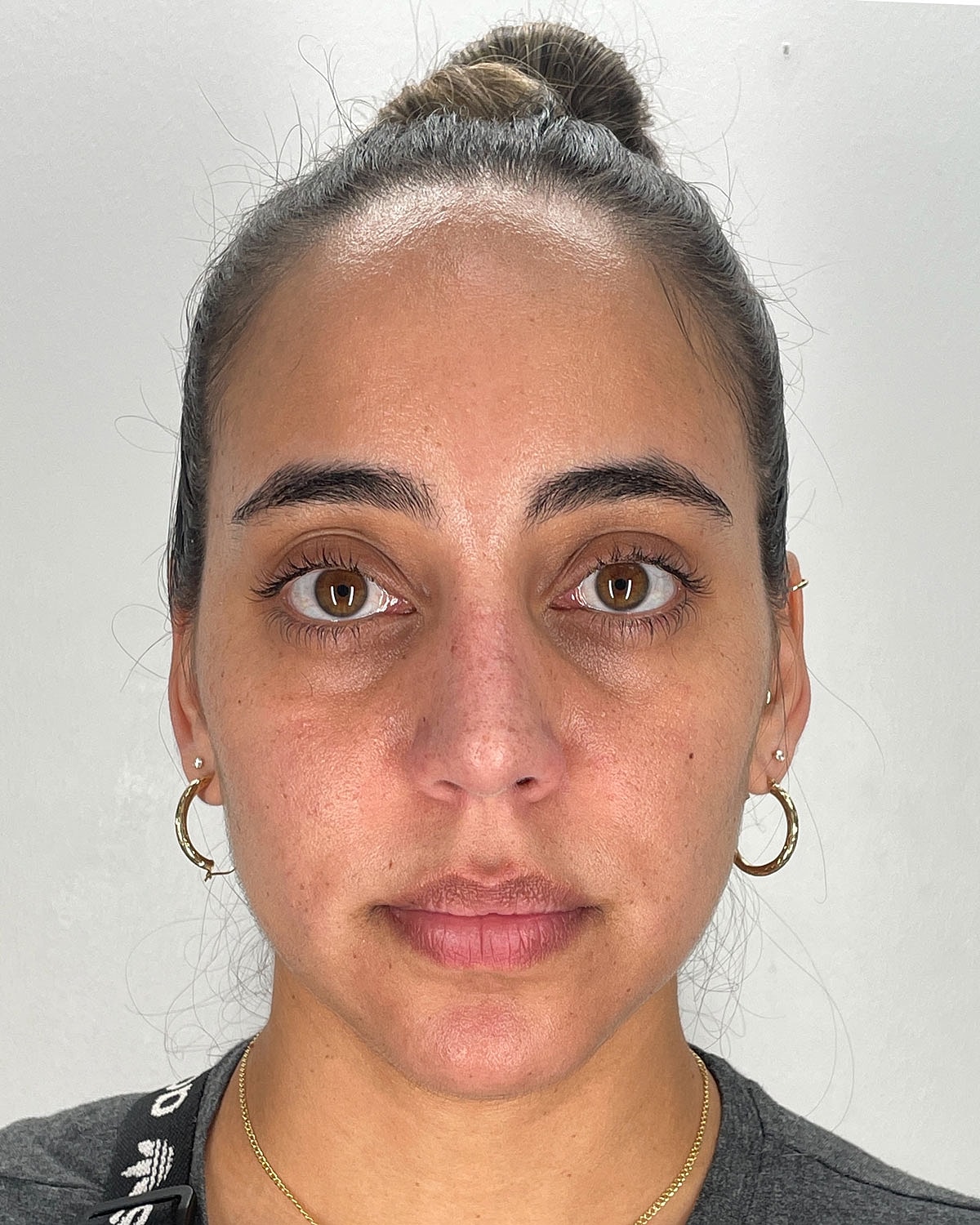 Rhinoplasty Before & After