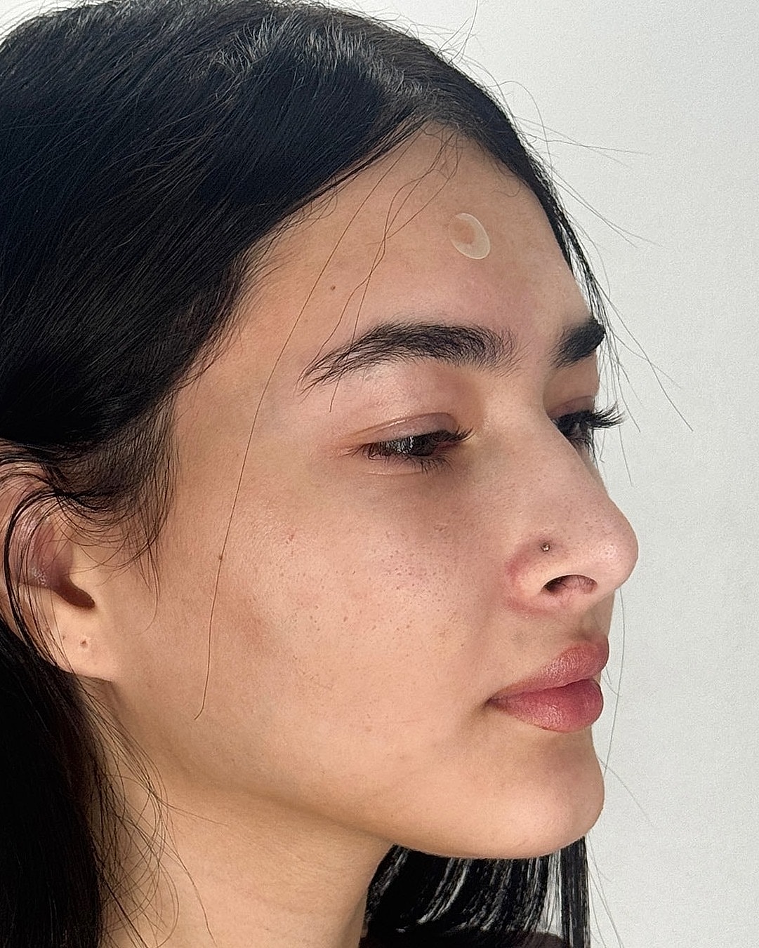 Rhinoplasty Before & After