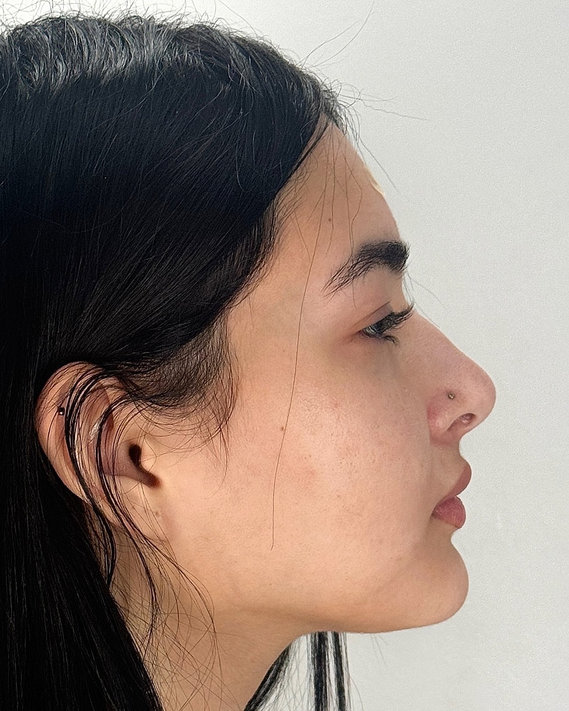 Rhinoplasty Before & After