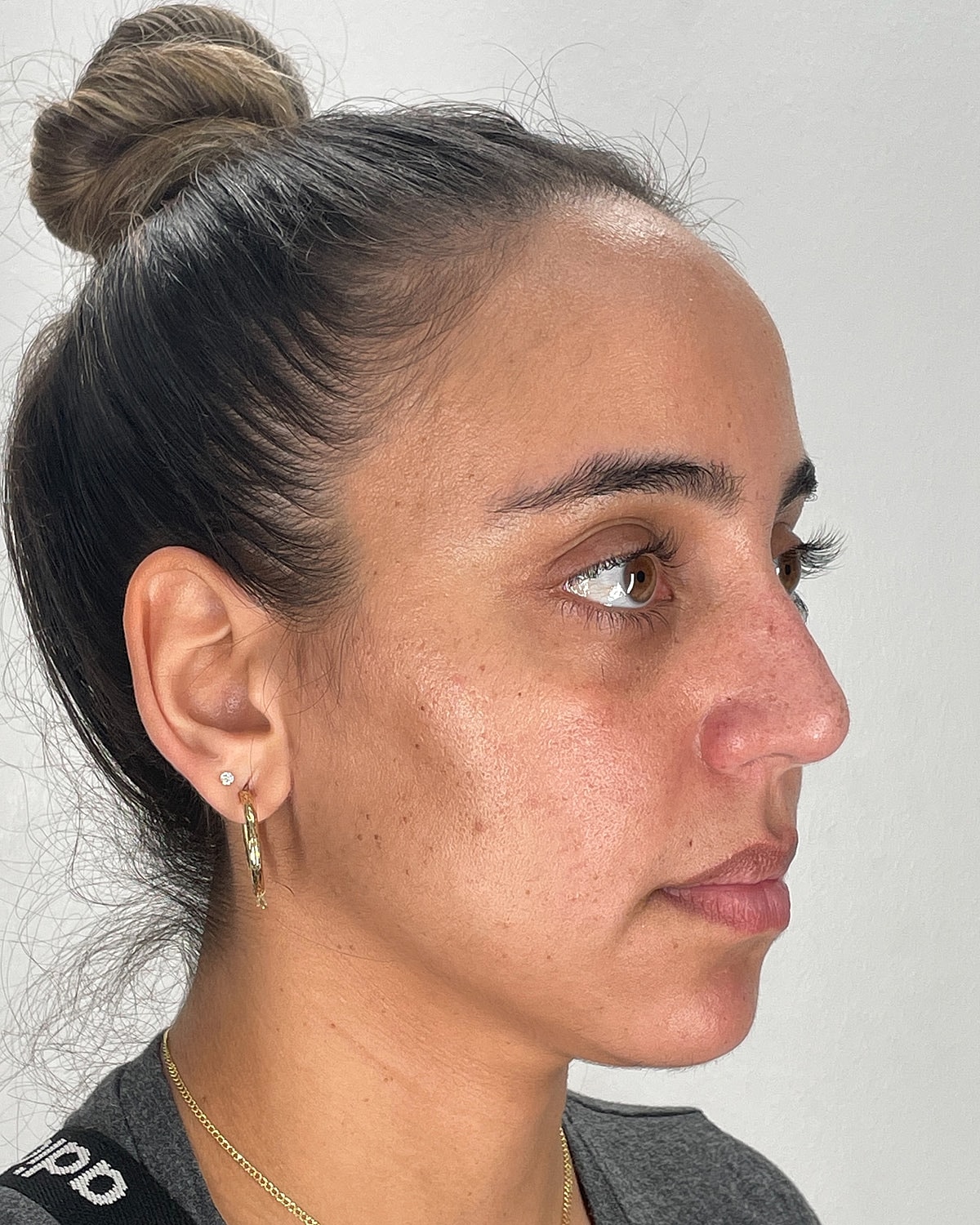 Rhinoplasty Before & After