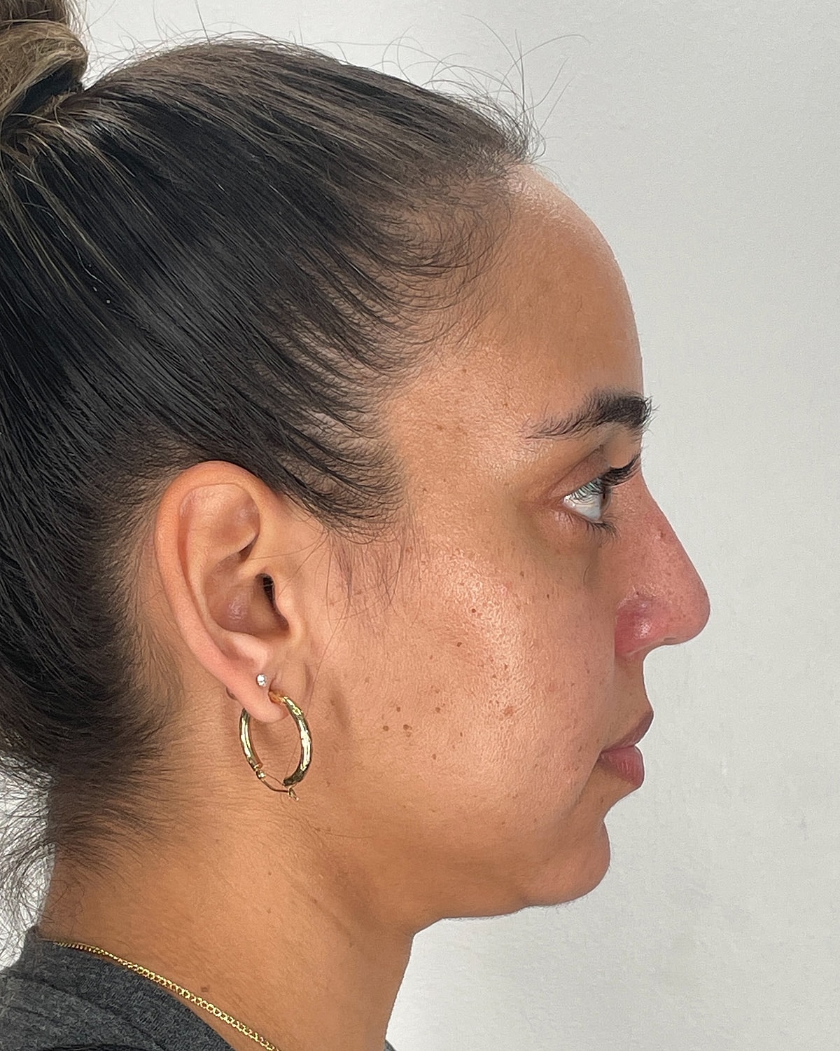 Rhinoplasty Before & After