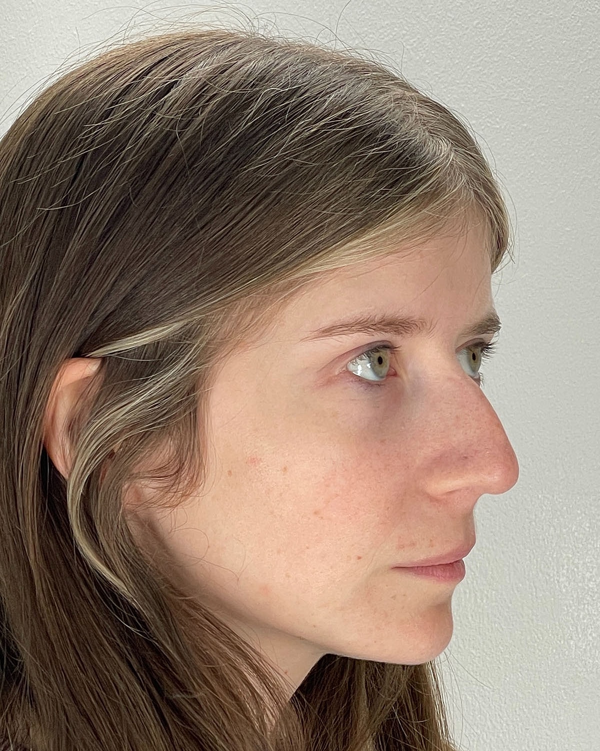 Rhinoplasty Gallery Before & After