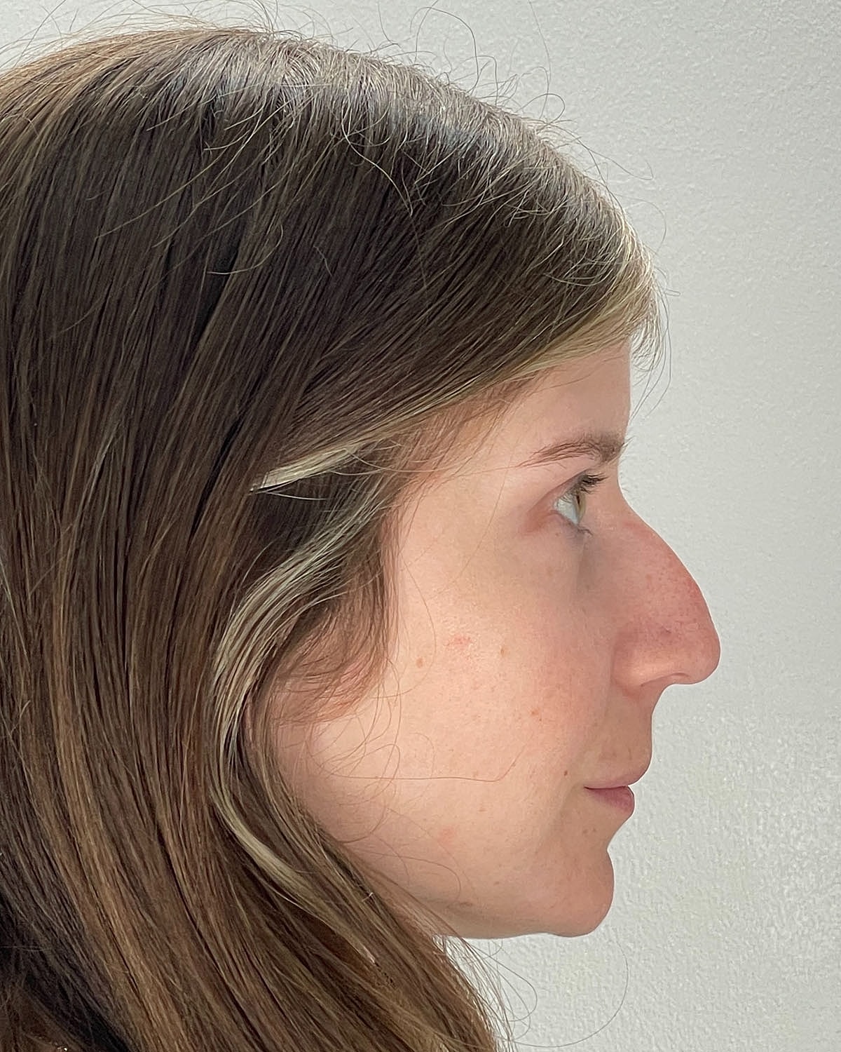 Rhinoplasty Gallery Before & After