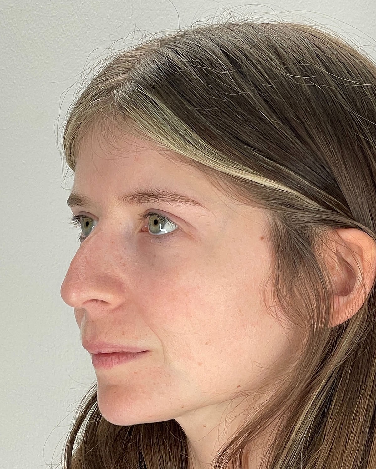 Rhinoplasty Gallery Before & After