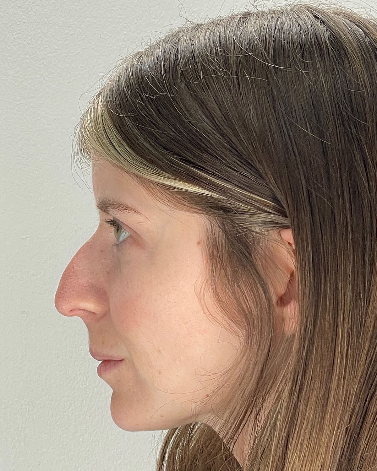 Rhinoplasty Gallery Before & After