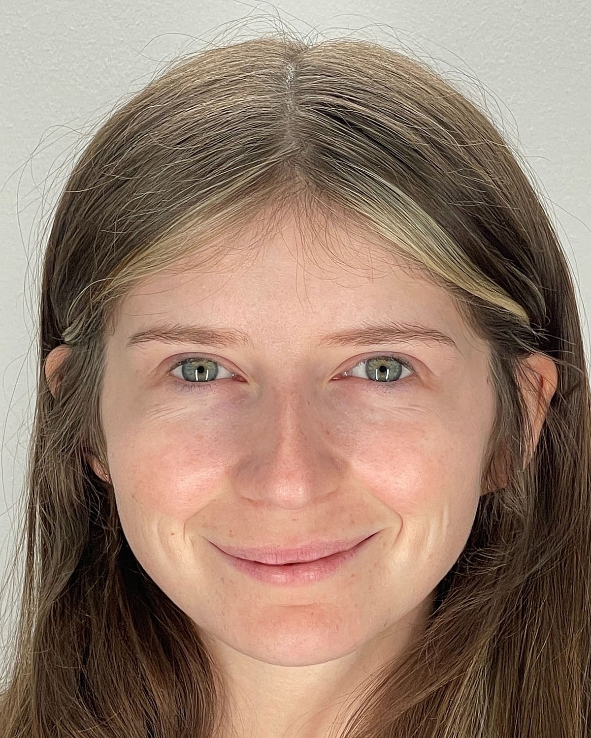 Rhinoplasty Gallery Before & After