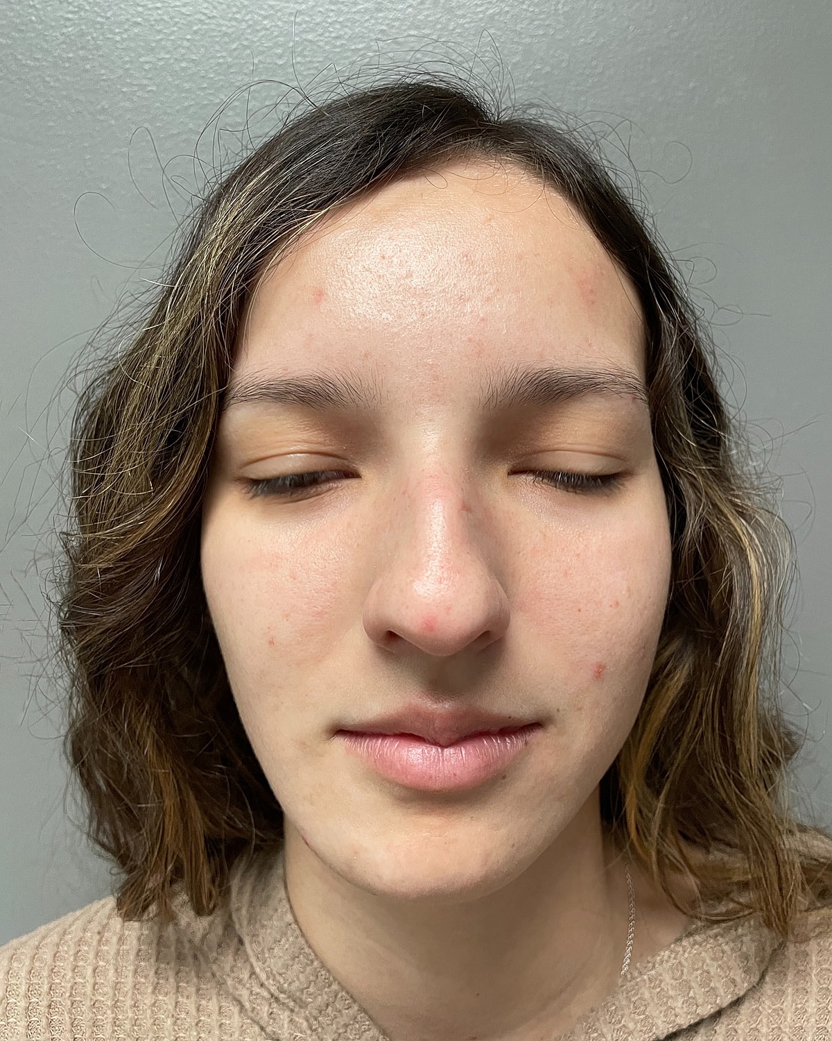 Rhinoplasty Before & After