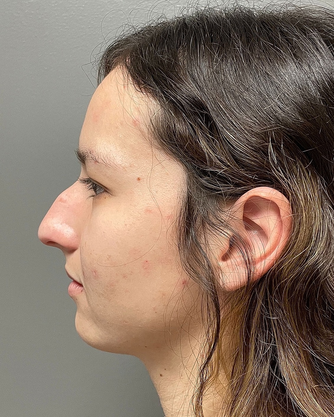 Rhinoplasty Before & After
