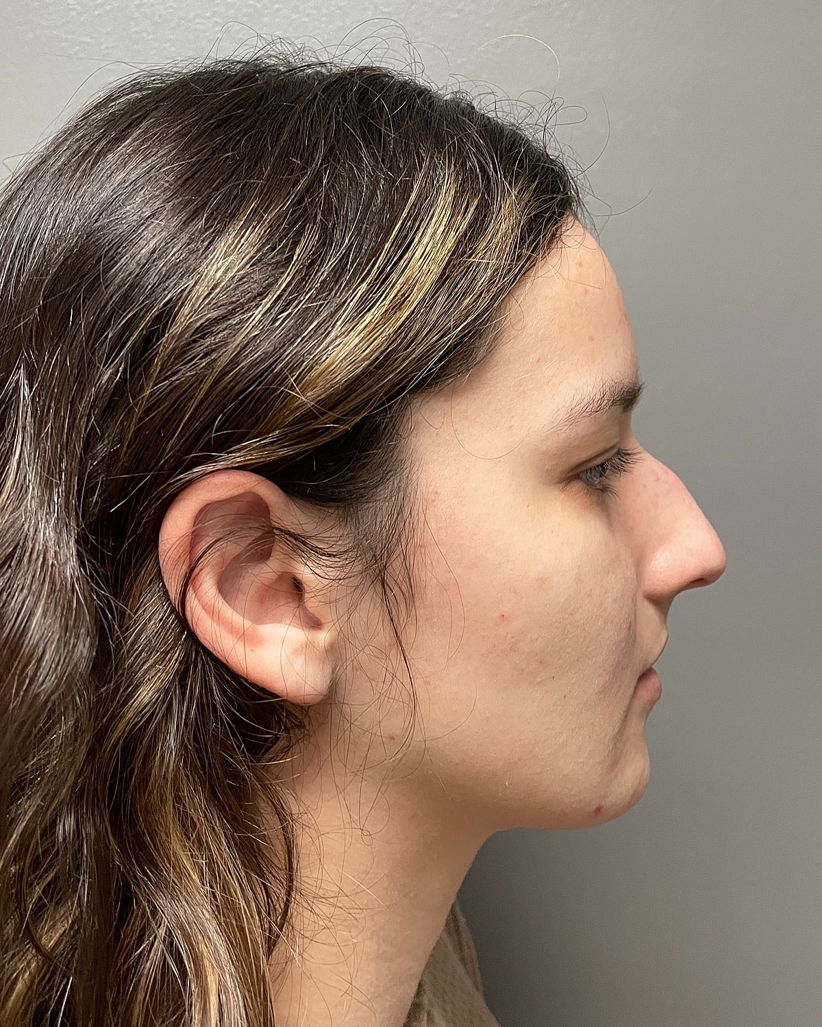 Rhinoplasty Gallery Before & After