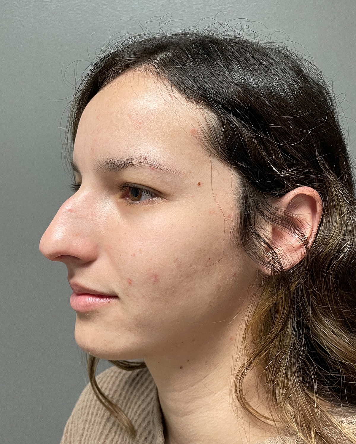 Rhinoplasty Before & After