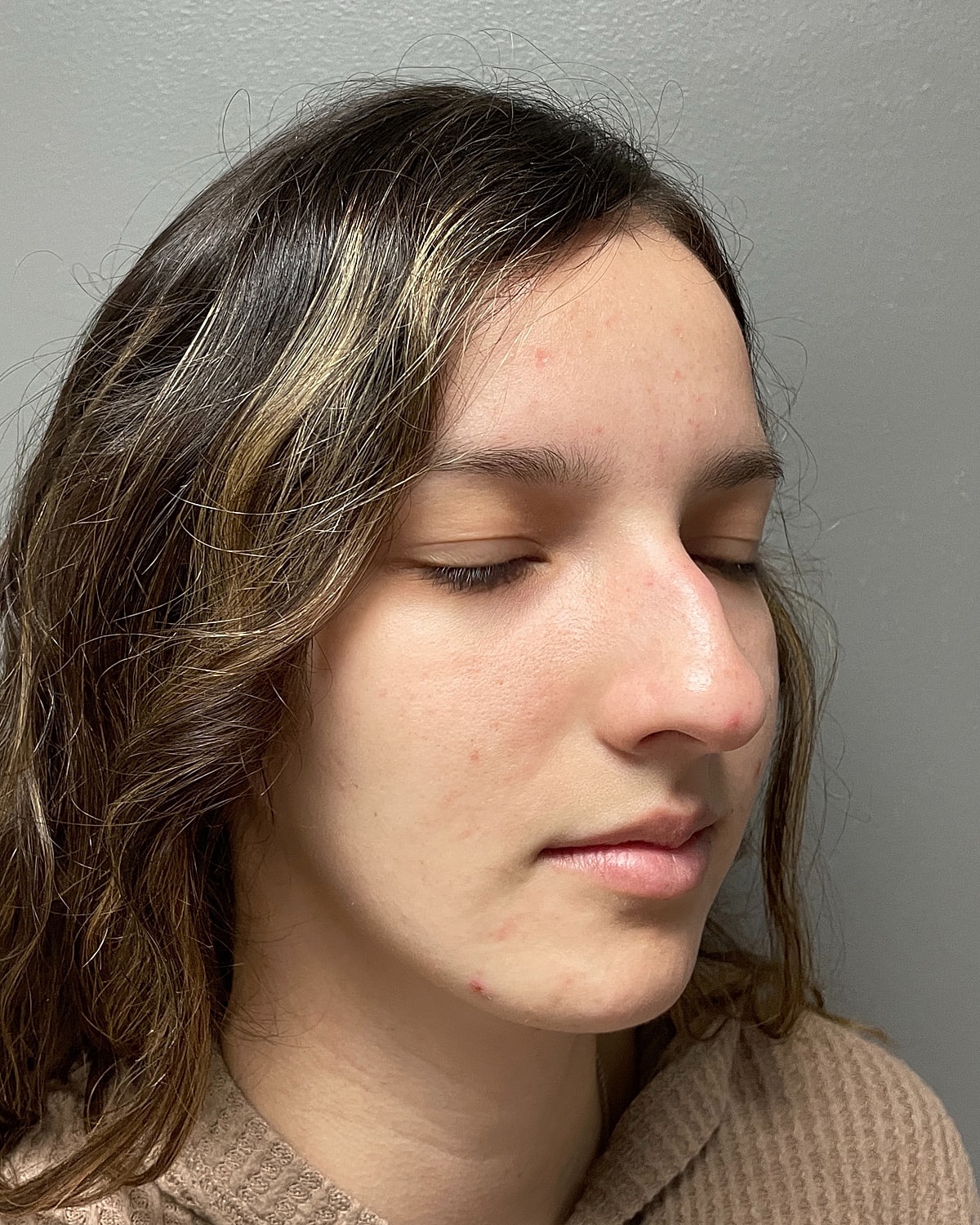 Rhinoplasty Gallery Before & After