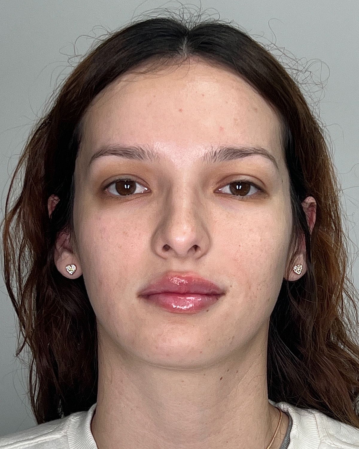 Rhinoplasty Before & After