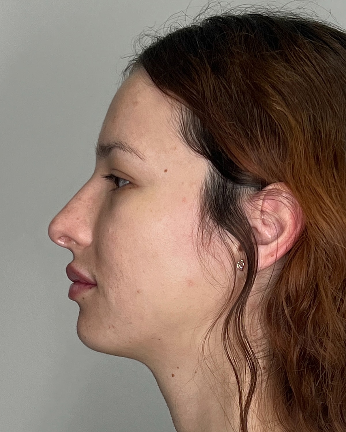 Rhinoplasty Before & After