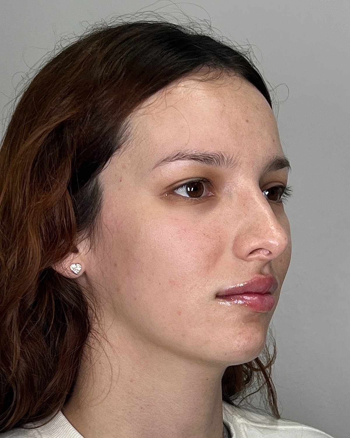 Rhinoplasty Gallery Before & After