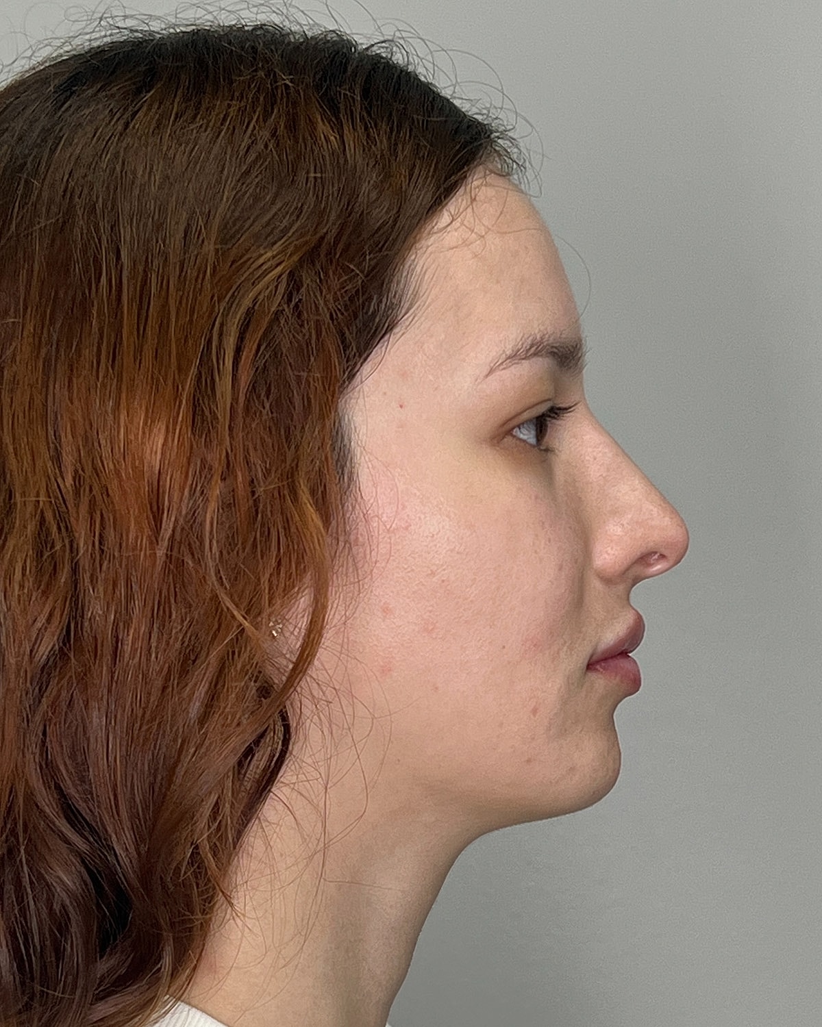 Rhinoplasty Gallery Before & After