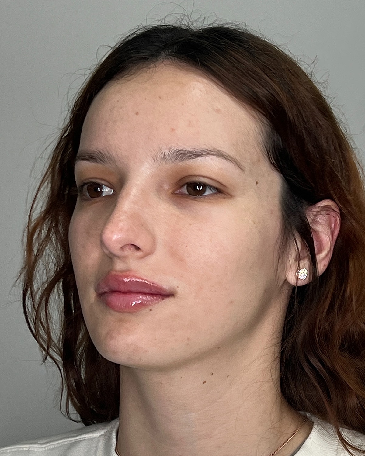 Rhinoplasty Before & After
