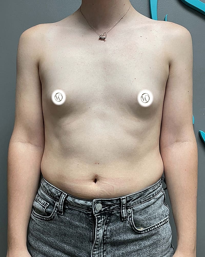 Mtf Top Surgery Before & After