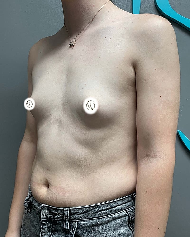 Mtf Top Surgery Before & After