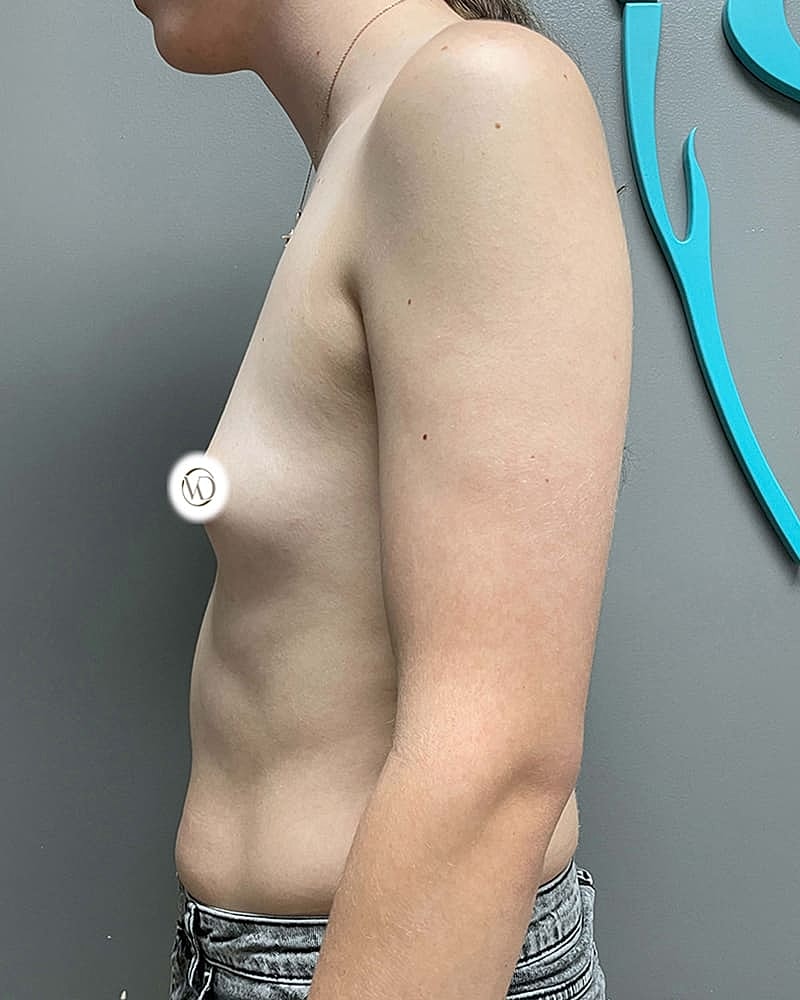 Mtf Top Surgery Before & After