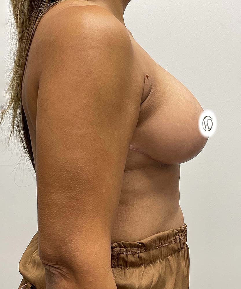 Breast Lift Implants Before & After