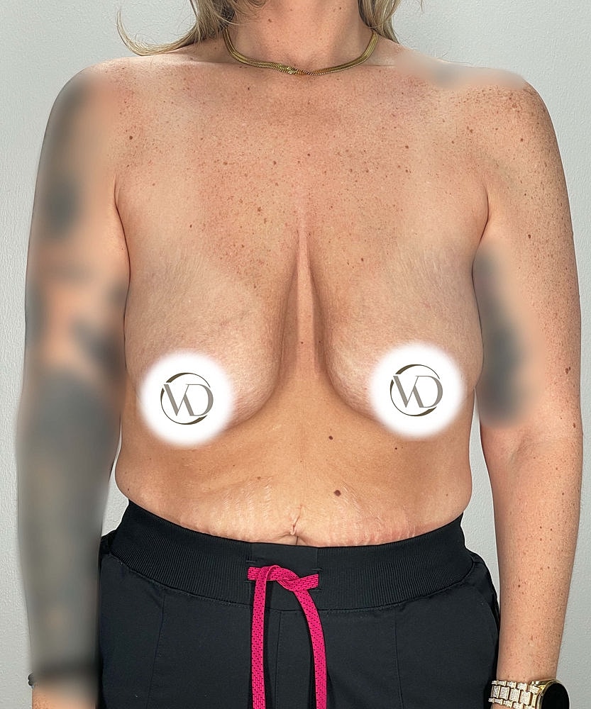 Breast Lift Implants Before & After