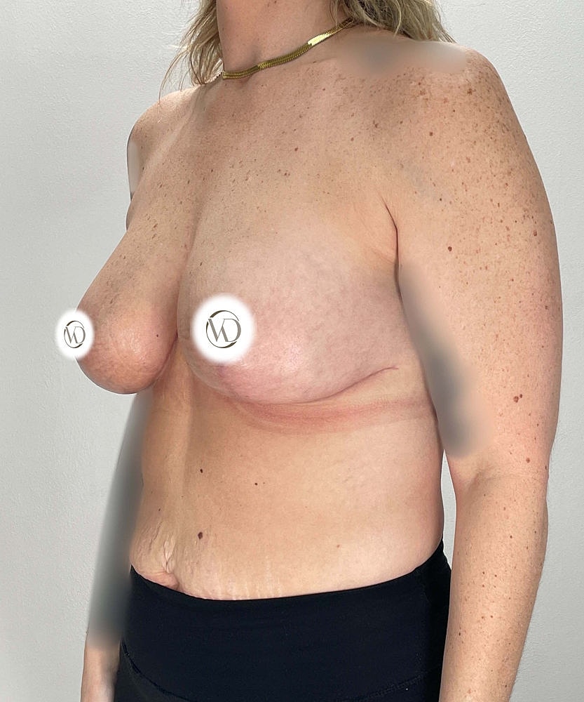 Breast Lift Implants Before & After