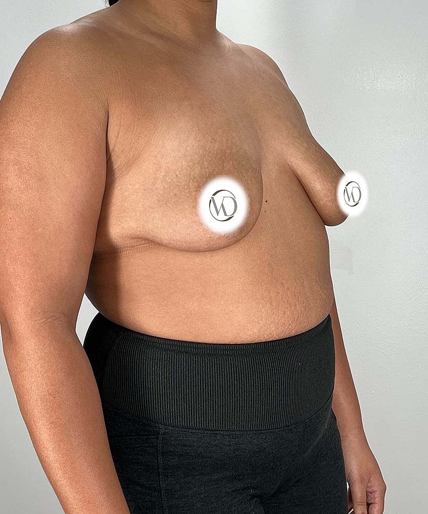Breast Lift Implants Before & After