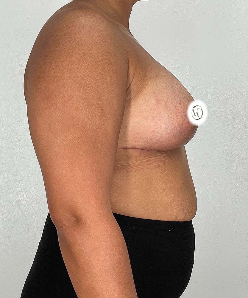 Breast Lift Implants Before & After