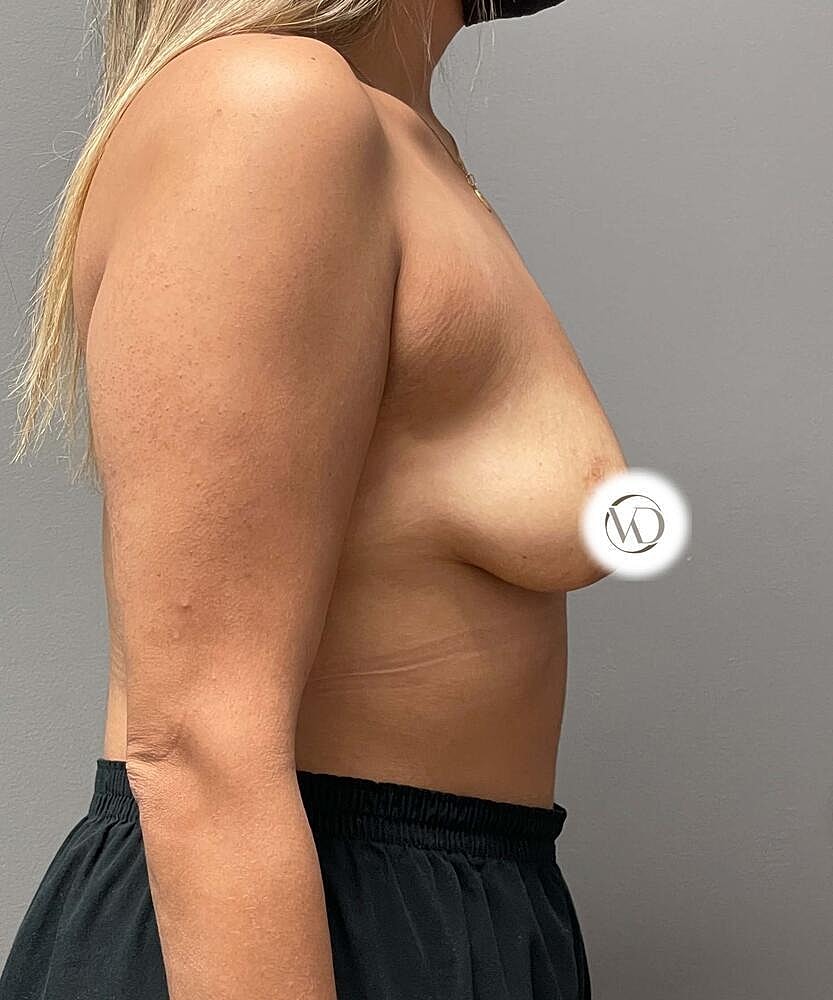 Breast Lift Implants Before & After